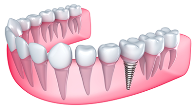 Photo of Diş İmplantı Tedavisi Nasıl Yapılır?